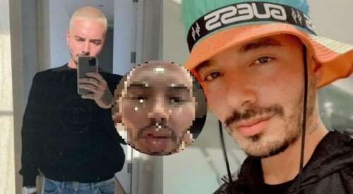 ¿J Balvin deformó su rostro con exceso de botox?